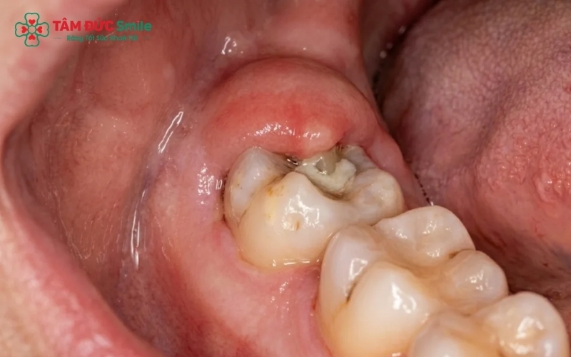 Răng khôn mọc lệch không chỉ gây viêm lợi trùm mà còn là 'thủ phạm' âm thầm làm sâu răng số 7 kế cận và gây tiêu xương hàm nếu không được xử lý kịp thời