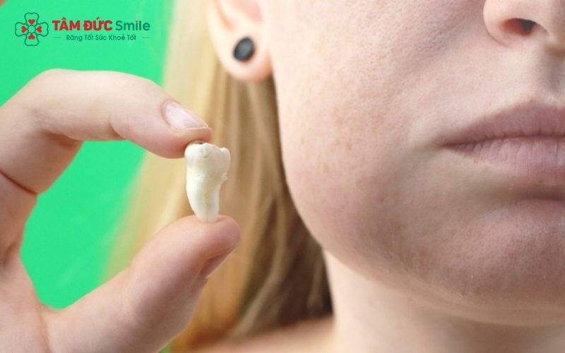 Sưng mặt sau nhổ răng khôn là phản ứng viêm tự nhiên của cơ thể nhằm bắt đầu quá trình chữa lành vết thương, thường sẽ giảm dần sau vài ngày