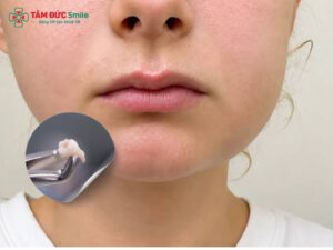 Nhổ răng khôn sưng mấy ngày? Cách giảm sưng sau khi nhổ răng khôn
