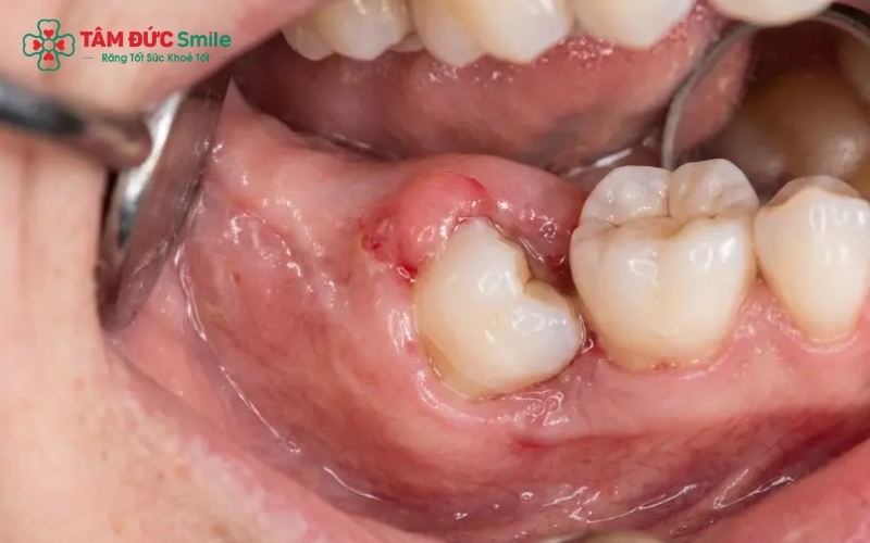 Đau, sưng hoặc rỉ máu nhẹ là phản ứng sinh lý bình thường của cơ thể sau tiểu phẫu.