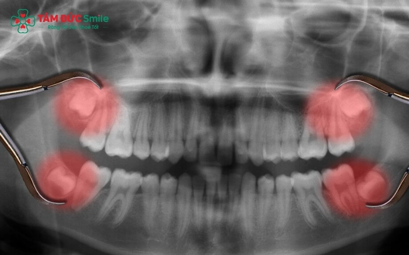 Nhờ công nghệ CT Cone Beam 3D, bác sĩ tại Tâm Đức Smile đánh giá chính xác vị trí răng, hướng chân răng và mối liên quan với dây thần kinh, đảm bảo an toàn tuyệt đối trước khi nhổ.