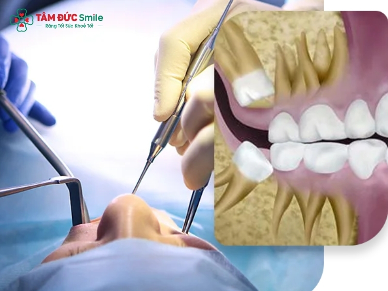Nhổ răng khôn có ảnh hưởng gì không?