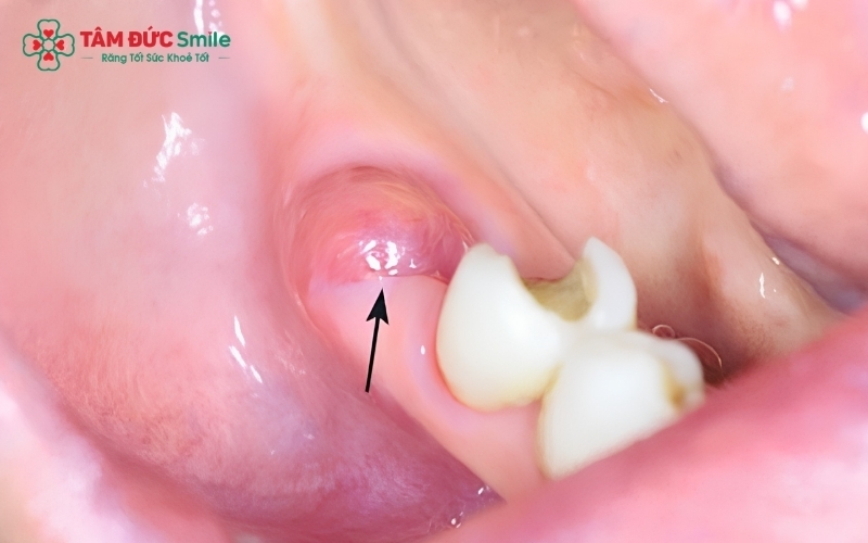 Hiểu rõ các phản ứng bình thường sau khi nhổ răng và các dấu hiệu biến chứng giúp bạn bình tĩnh xử lý cũng như biết khi nào cần liên hệ bác sĩ kịp thời