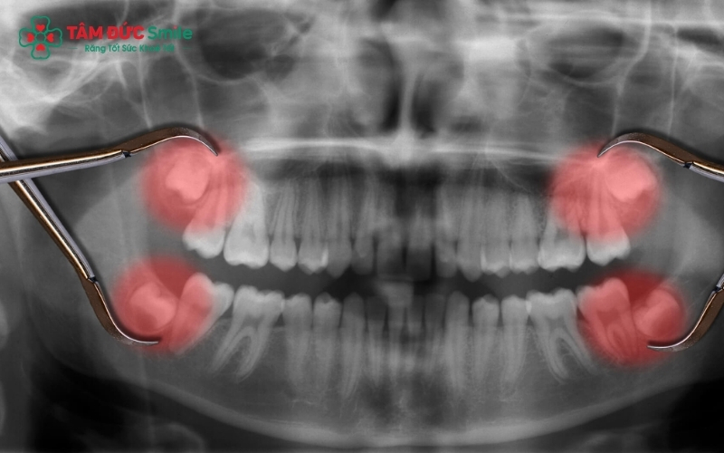 Sau khi kiểm tra phim chụp CT Cone Beam 3D, bác sĩ sẽ đánh giá xem tình trạng 2 răng khôn của bạn có đủ điều kiện để thực hiện nhổ cùng lúc hay không