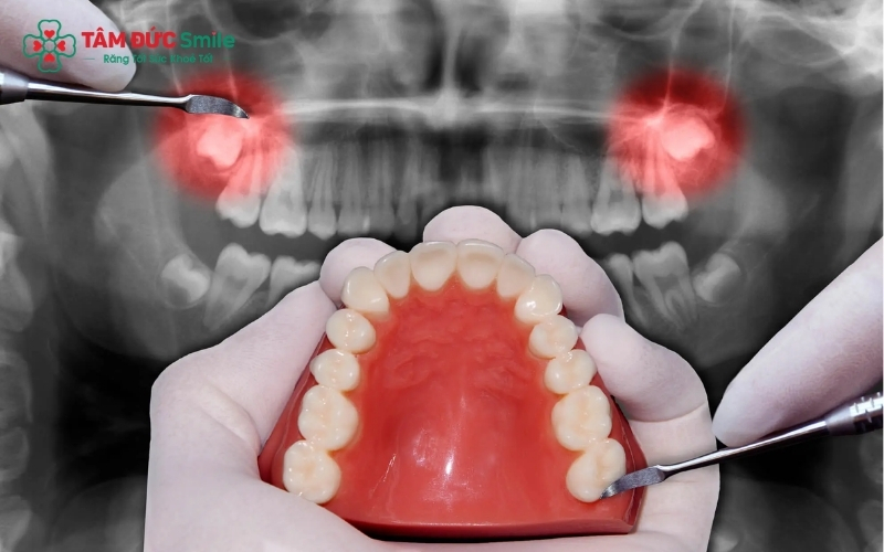Tùy vào độ khó của răng và lịch trình cá nhân, bác sĩ sẽ cùng bạn cân nhắc giữa việc tối ưu thời gian hay tối ưu khả năng ăn nhai sau tiểu phẫu