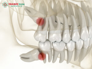 Nhổ 2 răng khôn cùng lúc có được không? 