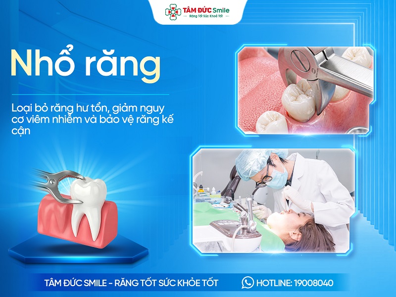 Nhổ răng là gì? Khi nào cần nhổ và Lưu ý cần biết