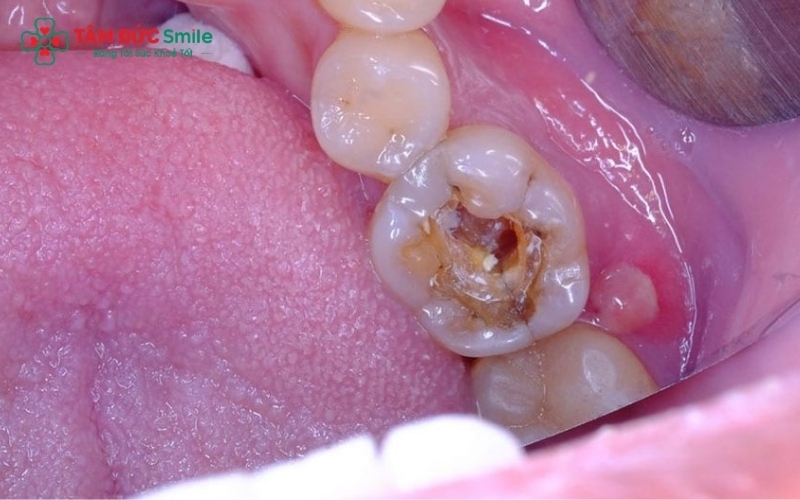 Sâu răng tiến triển sâu vào tủy hoặc áp xe chân răng là những nguyên nhân hàng đầu gây ra các cơn nhức răng dữ dội và kéo dài.