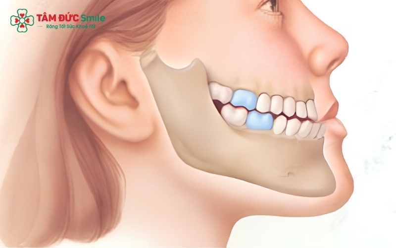 Niềng răng không mặc định gây hóp má, thường là sự kết hợp giữa thay đổi chế độ ăn uống, cân nặng và sự thích nghi của cơ nhai.