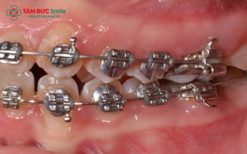 Cảm giác ê buốt hay cộm vướng mô mềm trong thời gian đầu là phản ứng bình thường của cơ thể khi răng bắt đầu dịch chuyển.