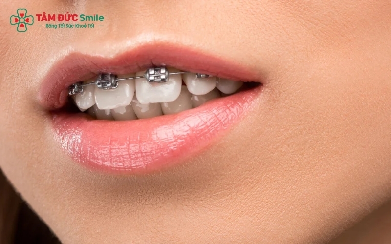 Tuân thủ thời gian đeo hàm duy trì và chăm sóc nha chu định kỳ giúp nụ cười của bạn duy trì vẻ đẹp lâu dài.
