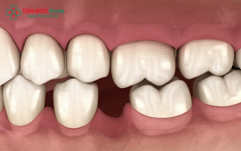  Việc bỏ bê hàm duy trì hoặc duy trì các thói quen xấu là nguyên nhân hàng đầu khiến răng dịch chuyển sau niềng.