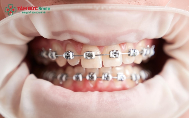 Niềng răng không chỉ mang lại nụ cười đều đẹp mà còn cải thiện khớp cắn và chức năng ăn nhai lâu dài.