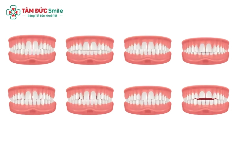 Niềng răng là giải pháp hiệu quả cho các tình trạng sai lệch răng như hô, móm, chen chúc hay sai khớp cắn.
