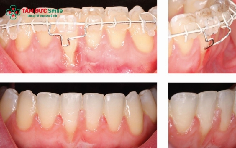 Khi được điều trị đúng kỹ thuật và tuân thủ hướng dẫn vệ sinh, niềng răng là phương pháp an toàn và hiệu quả.