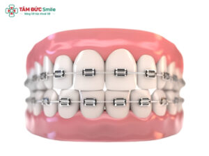 Niềng răng có tốt không? Lợi ích, tác hại và lưu ý quan trọng khi niềng