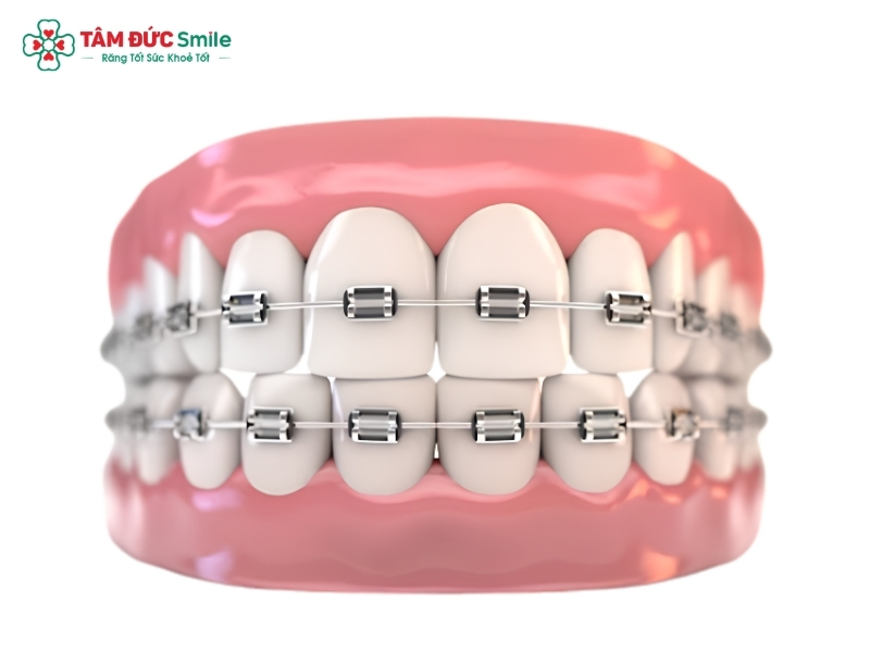 Niềng răng có tốt không? Lợi ích, tác hại và lưu ý quan trọng khi niềng