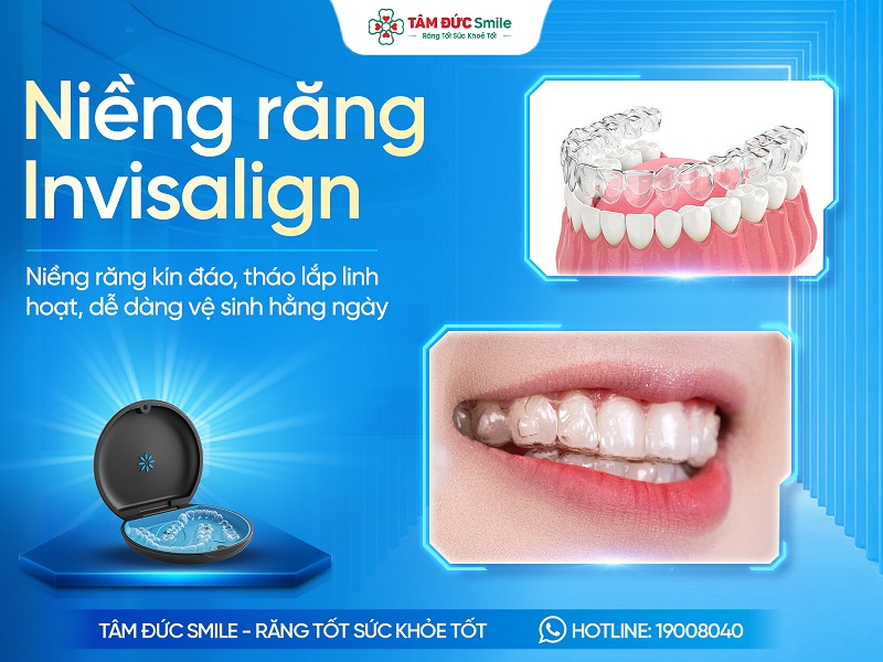 Niềng răng trong suốt Invisalign là gì? Giá, Ưu nhược điểm và Quy trình thực hiện