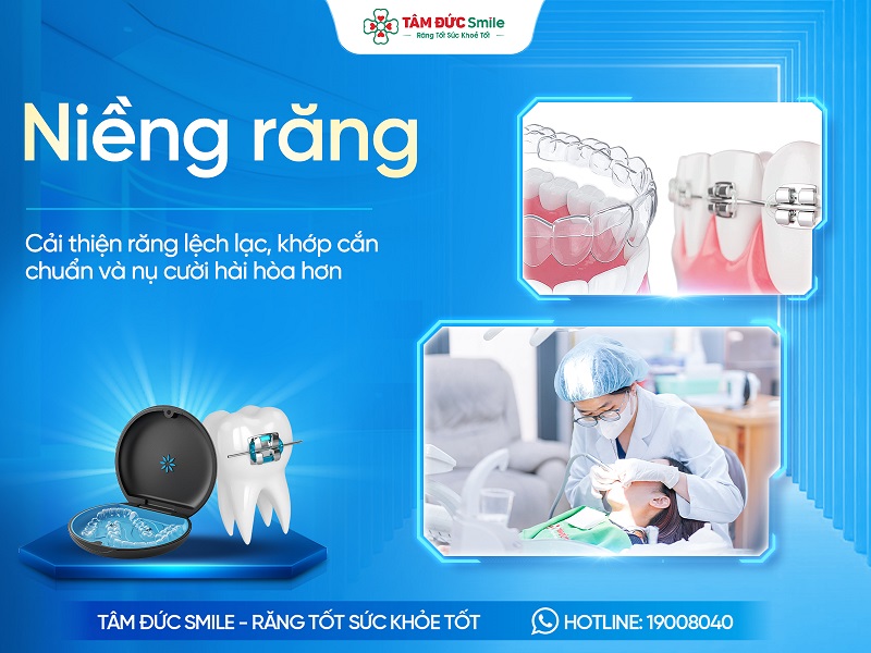 Niềng răng – Phương pháp chỉnh nha an toàn cho người lớn và trẻ em