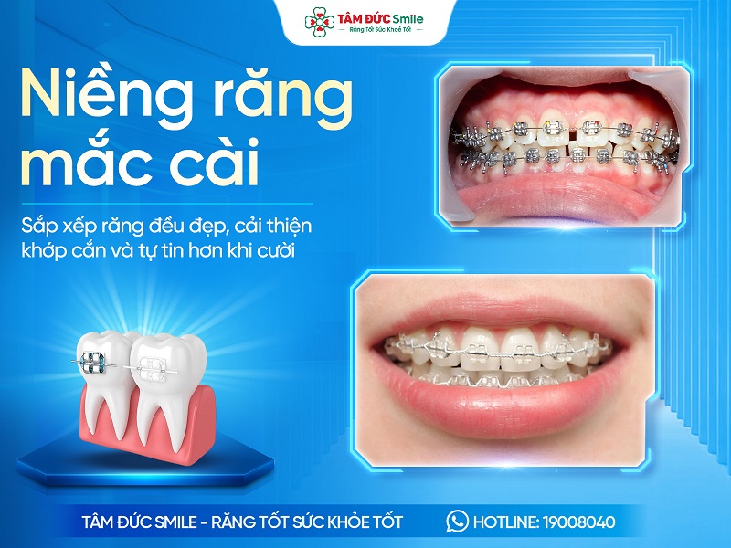 Niềng răng mắc cài: Giá, quy trình và các loại phổ biến