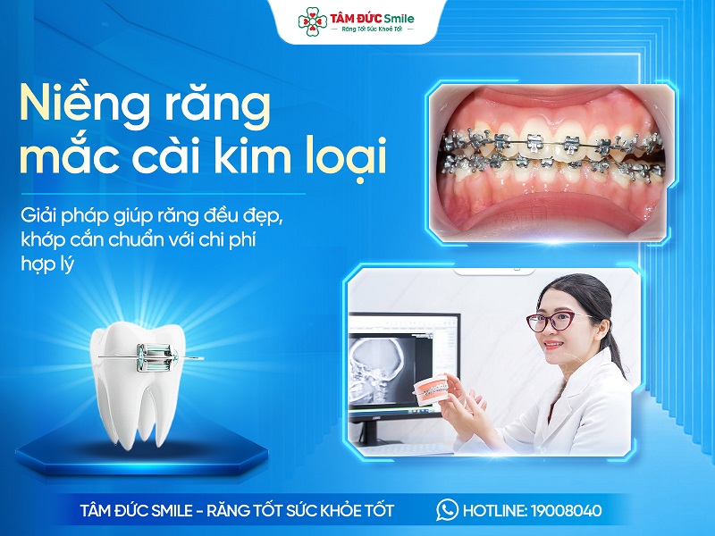 Niềng răng mắc cài kim loại là gì? Chi phí, Ưu nhược điểm, Quy trình và Địa chỉ uy tín