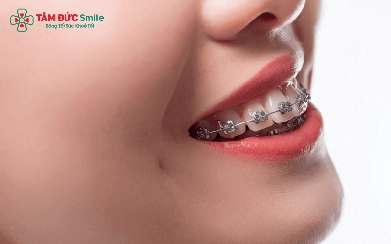 Niềng răng giúp điều chỉnh độ chìa của răng cửa, mang lại nụ cười cân đối và khớp cắn chuẩn.