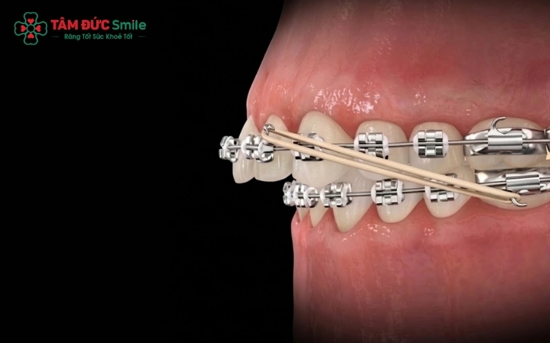 Niềng răng vẩu đa dạng phương pháp giúp khách hàng linh hoạt lựa chọn theo nhu cầu và ngân sách.