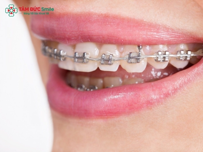 Niềng răng vẩu là gì? Các phương pháp niềng răng vẩu phổ biến hiện nay