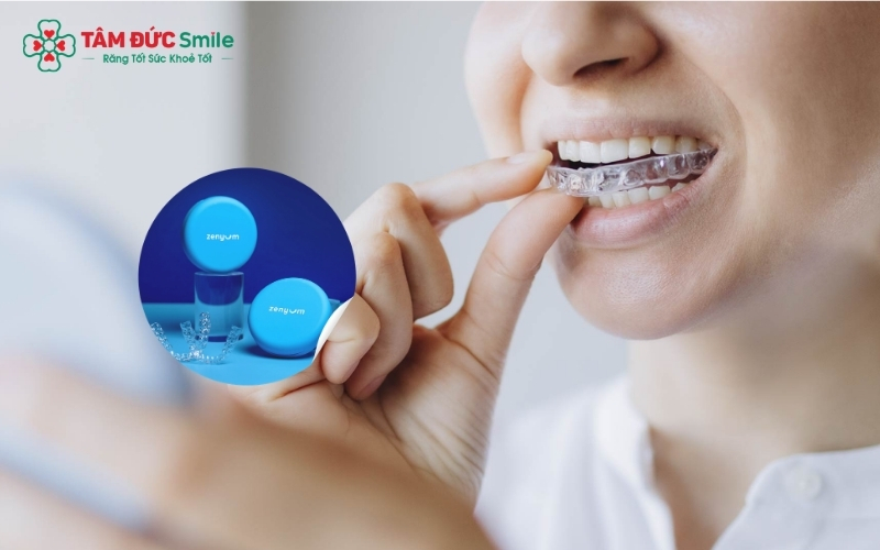 Niềng răng Zenyum sử dụng chuỗi khay trong suốt được cá nhân hóa, mang lại giải pháp chỉnh nha thẩm mỹ, kín đáo và vô cùng thuận tiện.