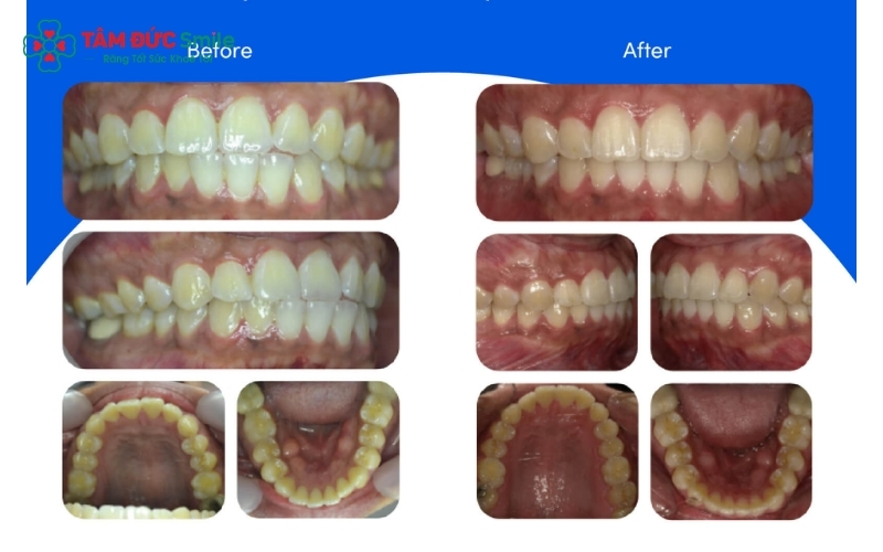 Niềng răng Zenyum là lựa chọn tối ưu cho những ai ưu tiên tính thẩm mỹ và sự thoải mái, với điều kiện tuân thủ tốt phác đồ điều trị