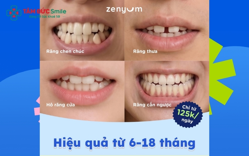 Với sự hỗ trợ của công nghệ số, Zenyum đặc biệt hiệu quả trong việc sắp xếp lại các trường hợp răng thưa hoặc chen chúc ở mức độ nhẹ đến trung bình.