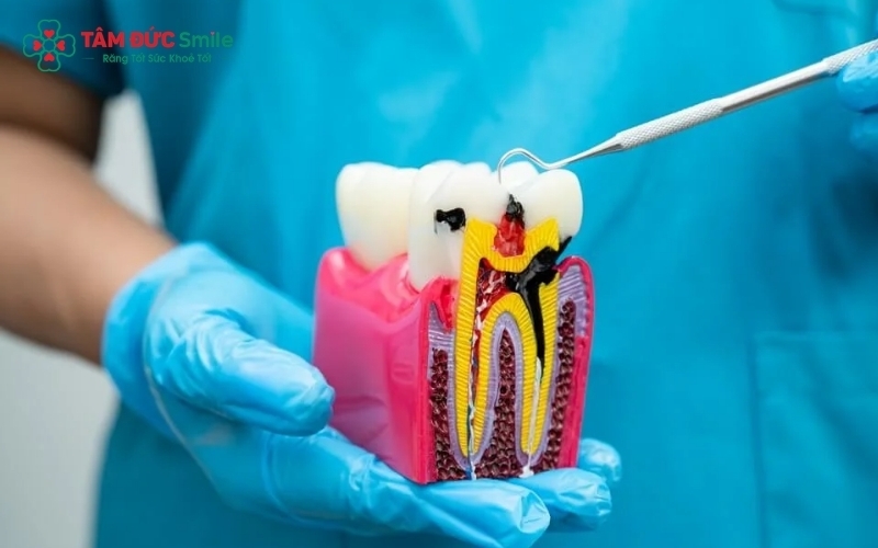 Sâu răng nếu không điều trị sớm sẽ tiến triển từ men răng, ngà răng vào tủy, dẫn đến viêm nhiễm và nguy cơ mất răng.
