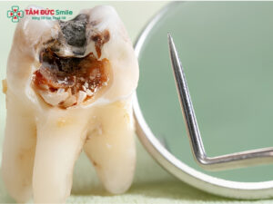 Các cách phòng ngừa sâu răng hiệu quả