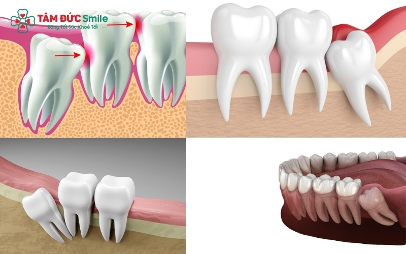 Răng khôn mọc lệch hoặc mọc ngầm thường âm thầm gây tổn thương chân răng số 7 và tiêu xương hàm, dù không gây ra triệu chứng đau đớn tức thì.