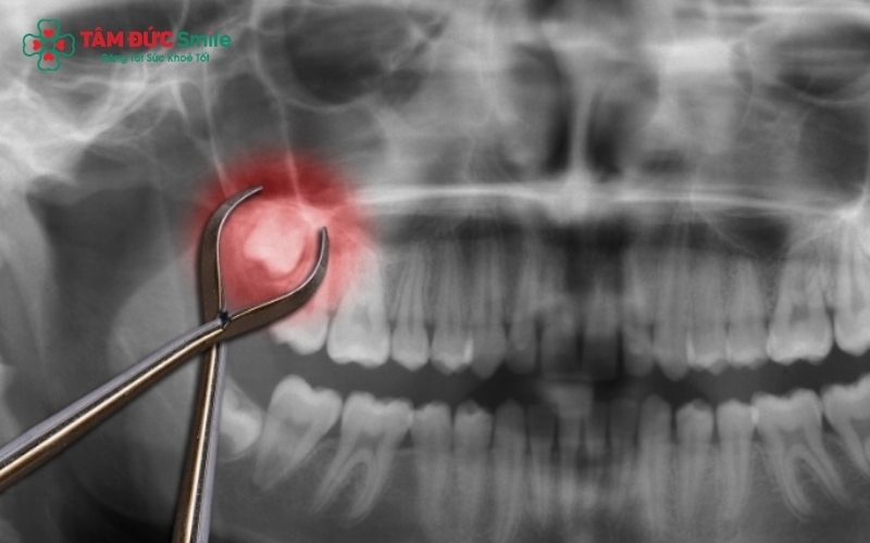 Răng khôn mọc thẳng, đúng vị trí và có thể vệ sinh sạch sẽ thường được bác sĩ chỉ định theo dõi định kỳ thay vì can thiệp nhổ bỏ.