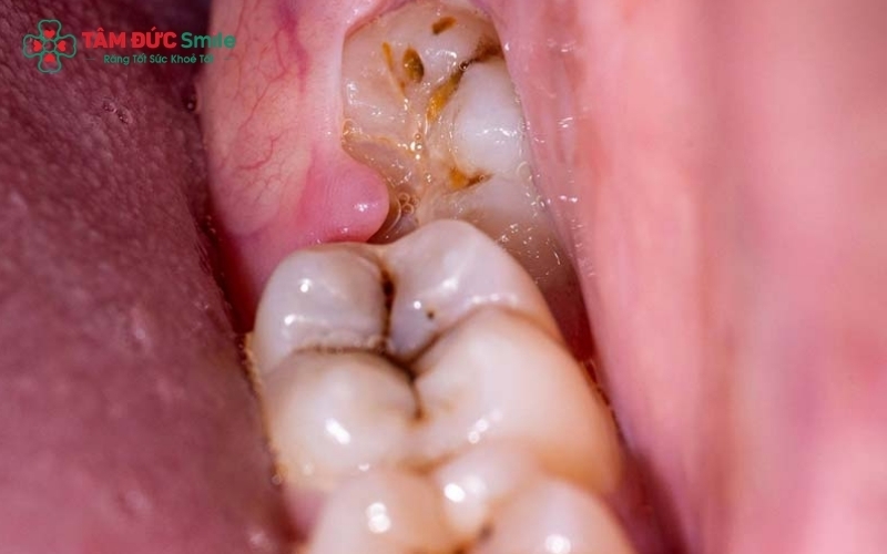 Răng khôn mọc lệch không chỉ gây đau mà còn là "kẻ giấu mặt" phá hủy răng số 7 kế cận.