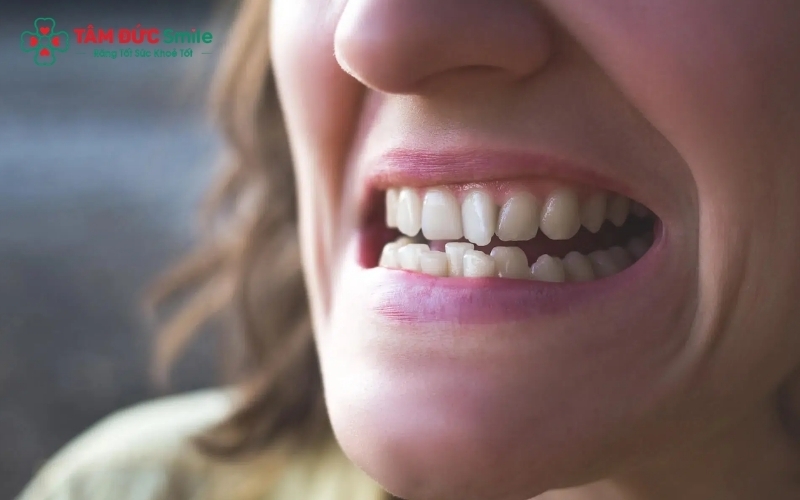 Răng mọc lệch xuất phát từ sự mất cân xứng giữa kích thước răng và xương hàm