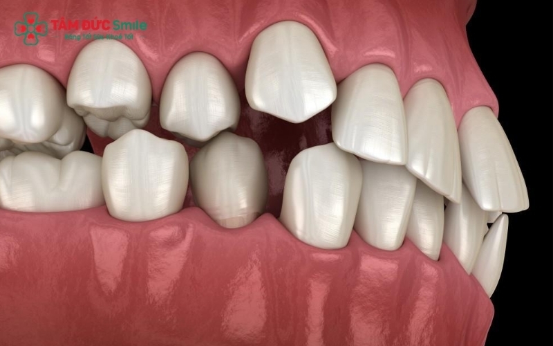 Răng mọc lệch không chỉ ảnh hưởng thẩm mỹ mà còn làm tăng nguy cơ sâu răng và các bệnh lý nha chu.