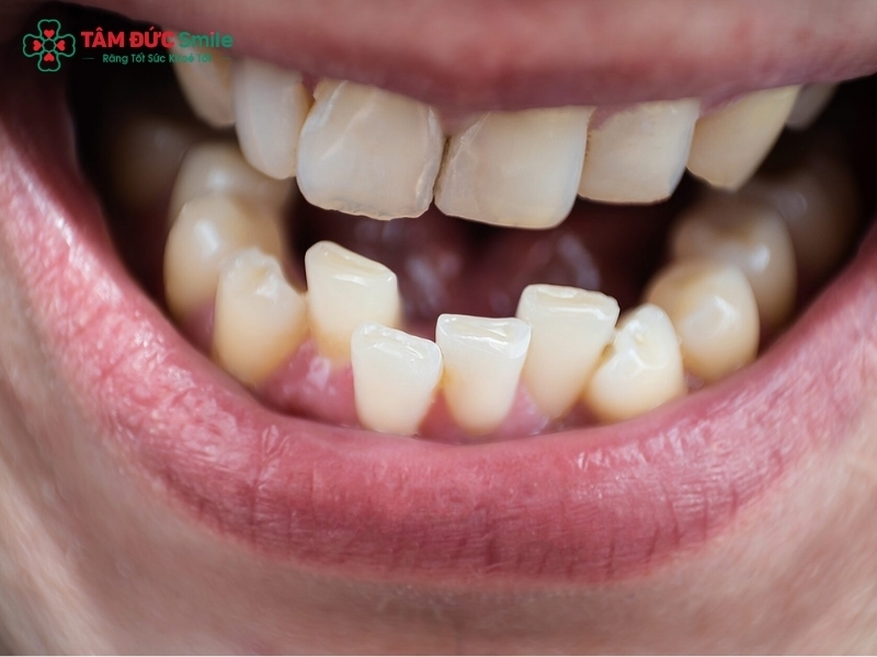 Răng mọc lệch: Nguyên nhân, tác hại và cách điều trị hiệu quả