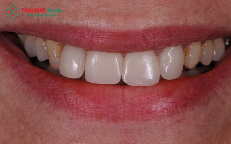 Lựa chọn loại răng sứ và kỹ thuật phục hình quyết định độ bền màu và thẩm mỹ lâu dài.