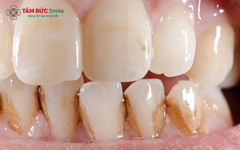 Đừng đợi đến khi răng sứ xỉn màu nặng hoặc đen viền nướu mới đến nha khoa kiểm tra.