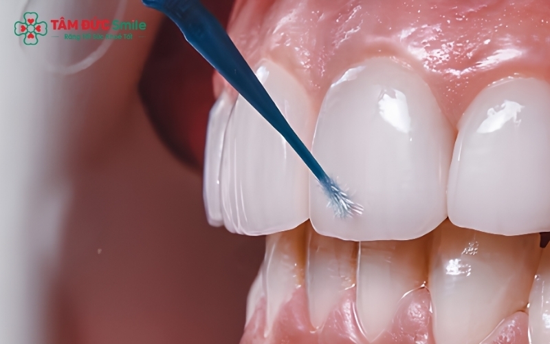 Nếu răng sứ chỉ bị ố màu bề mặt, bác sĩ có thể làm sạch và đánh bóng để khôi phục độ sáng bóng ban đầu.