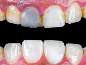 Răng sứ có bị xuống màu không? Nguyên nhân và cách khắc phục hiệu quả