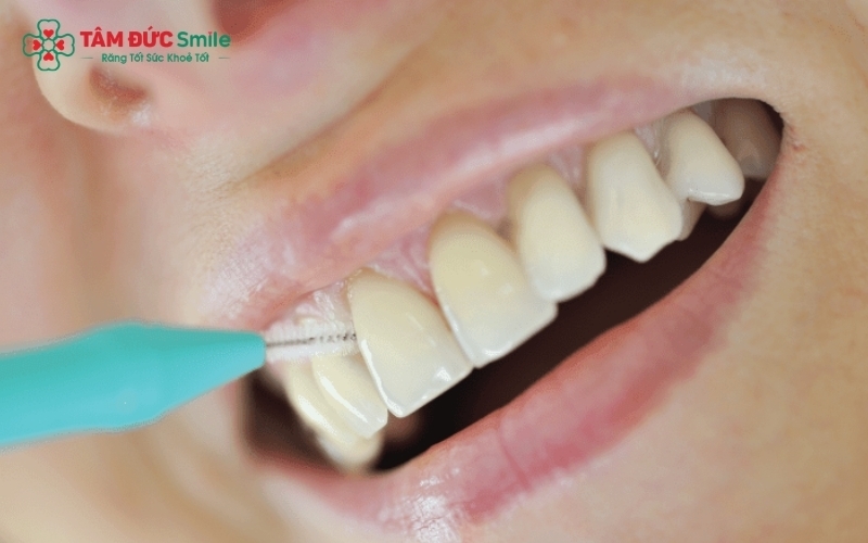 Chăm sóc răng sứ cũng cần kỹ lưỡng như răng thật để duy trì nụ cười bền màu theo năm tháng.