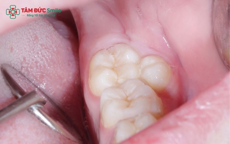 Răng thừa có thể mọc trên cung hàm hoặc nằm ngầm trong xương hàm, đôi khi chỉ được phát hiện khi chụp phim X-quang định kỳ.