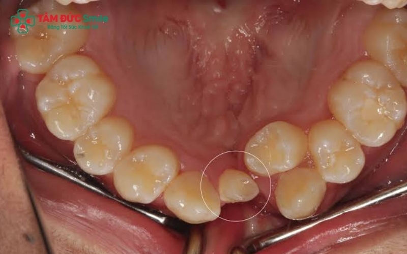 Răng thừa không chỉ gây mất thẩm mỹ mà còn là nguyên nhân gián tiếp khiến răng vĩnh viễn mọc lệch và tạo điều kiện cho thức ăn mắc kẹt, gây sâu răng.