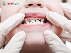 Sâu răng ở trẻ em: Nguyên nhân, dấu hiệu và cách điều trị hiệu quả