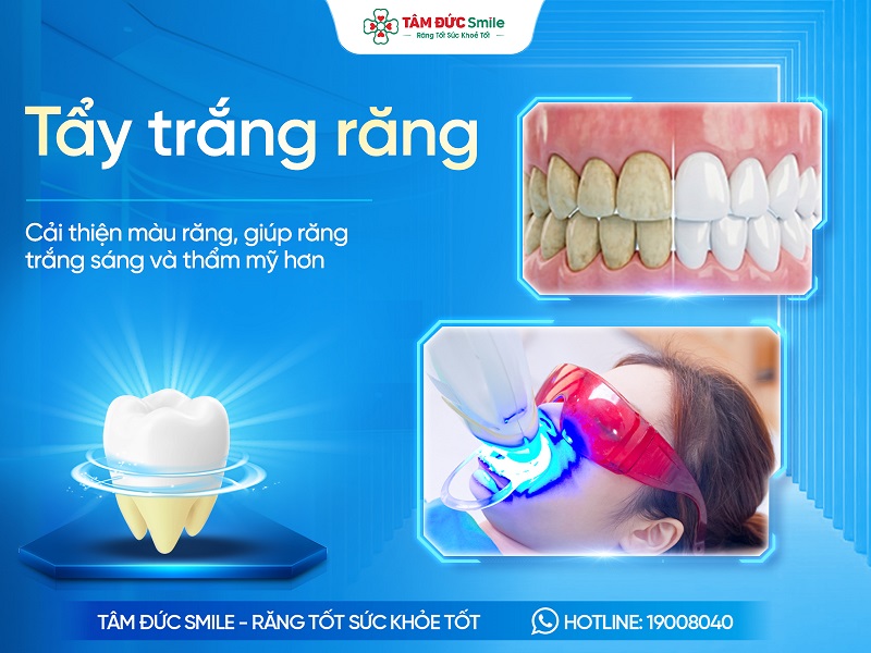 Tẩy trắng răng là gì? Các phương pháp làm răng răng an toàn và hiệu quả