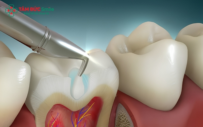 Trám răng là thủ thuật nha khoa nhanh chóng, giúp phục hồi hình dáng và chức năng ăn nhai của răng bằng vật liệu Composite có màu sắc tự nhiên như răng thật.