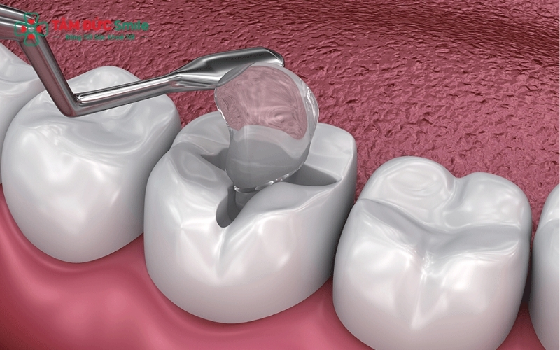 Trám răng sâu giúp phục hồi hình dáng, trả lại vẻ thẩm mỹ và bảo vệ cấu trúc răng thật trước khi tổn thương lan rộng vào tủy.